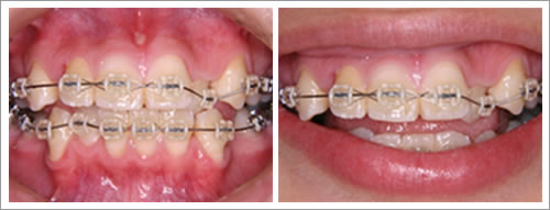 咬み合わせ改善なら静岡市葵区の近藤矯正歯科医院へ